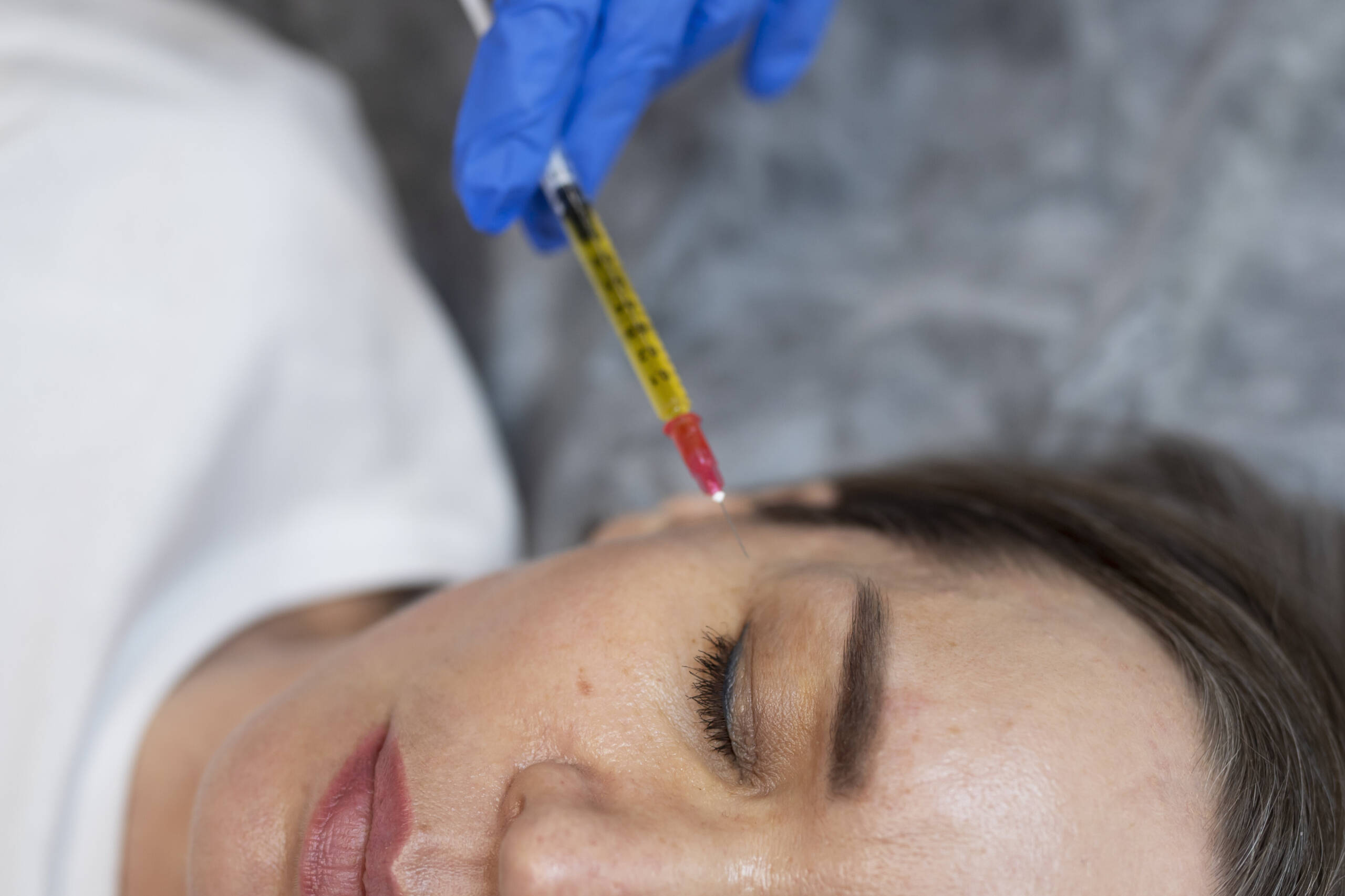 PRP Treatment (Platelet-Rich Plasma)